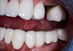 Patient teeth, before Dental Crowns treatment, front view - patient 4