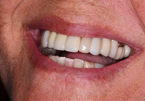Patient teeth, after Dental Crowns treatment, front view - patient 3